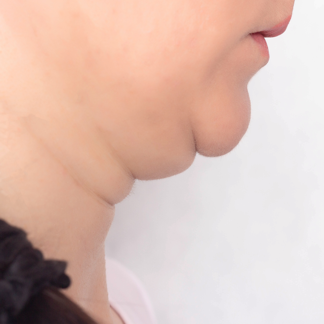 Traitement double menton sans injection